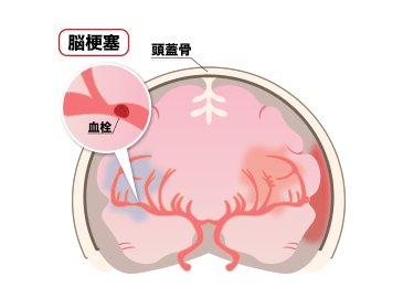 脳梗塞