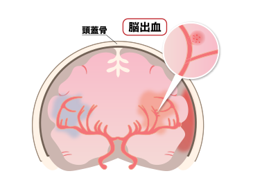 脳出血