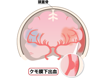 くも膜下出血